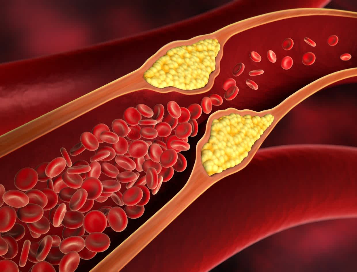 Are_There_Symptoms_of_High_Cholesterol (1)