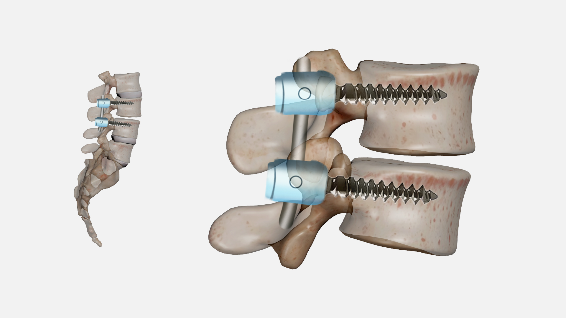6.spinal-fusion