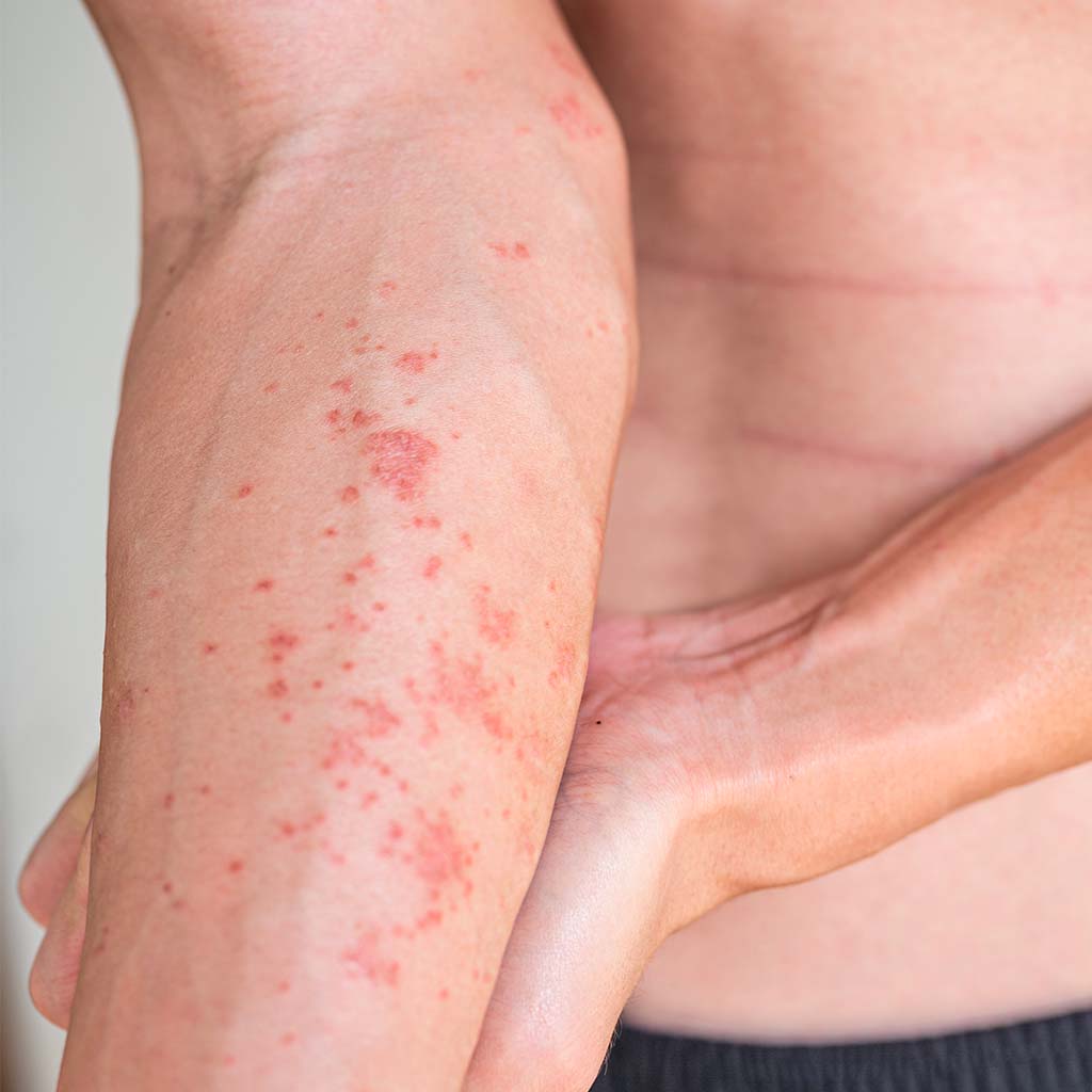 eczema-how-to-recognize-and-treat-it